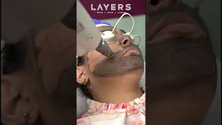 Experience Advanced QSwitch Laser Treatment at Layers Clinic qswitch lasertreatment layers [upl. by Odla]