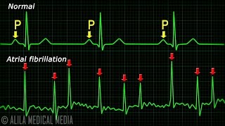 Atrial Fibrillation Anatomy ECG and Stroke Animation [upl. by Angle]