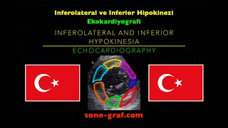 Ekokardiyografi  İnferolateral Ve İnferior Hipokinezi [upl. by Irotal439]