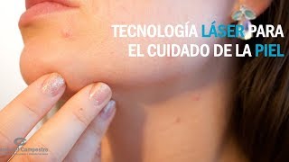 Tecnología láser para quitar manchas en la piel [upl. by Tacy]