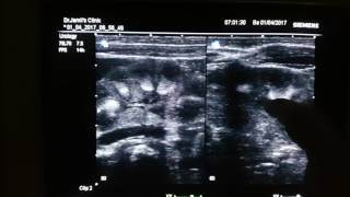 Medullary Nephrocalcinosis Ultrasound [upl. by Sladen]