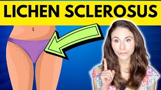 Lichen Sclerosus WHY YOU HAVE IT amp HOW TO TREAT IT [upl. by Retsevel586]