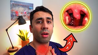 What Causes a Sore Throat HOME Remedies and Cures for Fast TREATMENT Doctor Explains [upl. by Eitsud]