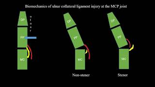 CAR  Case of the week  Case 3  Stener lesion [upl. by Jamie]