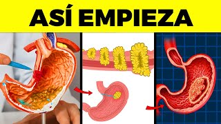 ¡Atención 5 Señales Comunes de Cáncer de Estómago que Nadie Nota Hasta que es Tarde [upl. by Dorita399]