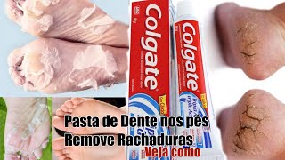 PASTA DE DENTE NOS Pés REMOVE RACHADURASBASTA USAR ASSIM [upl. by Mairhpe]