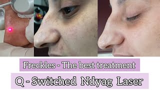 Best treatment for freckles  NdYag laser  Dr Anuj Pall MD PhD FISD USA [upl. by Peltz]