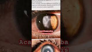 Keratitis Eye disease 🦠  Optometry solution [upl. by Aihsatsan]