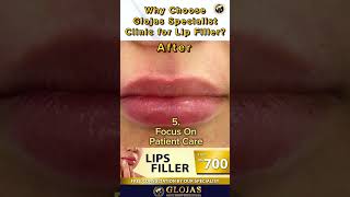 Lip Filler for Fuller More Luscious Lips  GLOJAS AESTHETIC CLINIC [upl. by Tavi]