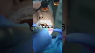 What Happens to The Abscess After Tooth Extraction  Dental Abscess  Daily Dentists [upl. by Burgwell623]