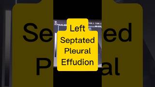 Septated Pleural Effusion  Lung Fluid  Dyspnoea ultrasound [upl. by Kantor363]