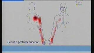 Dolores de los brazos originados por Nódulos Dolorosos Trigger Points  Dr Isaac Jakter [upl. by Nollahp]