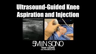 UltrasoundGuided Knee Aspiration and Injection A StepbyStep Guide [upl. by Notgnillew]