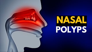 NASAL POLYPS Causes SIgns and Symptoms Diagnosis and Treatment [upl. by Dannye]