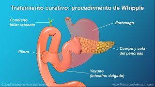 Cáncer de páncreas tratamiento y resultados [upl. by Auberta]