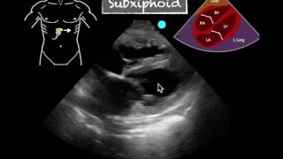 POCUS Cardiac Subxiphoid Severely Reduced EF [upl. by Oad]