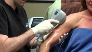 Exilis for Skin Tightening on a Womans Arms with Dr Seiler [upl. by Leaffar]