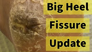 Big Heel Fissure Update The Heel Has Finally Healed [upl. by Deppy]