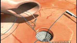 Animation for harveststring used in proximal anastmosis of vein graft with aorta [upl. by Memory]