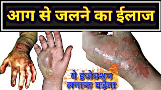 आग से जलने का बेस्ट ईलाज  Skin burn treatment  fire burn best treatment skinburn [upl. by Kwapong]