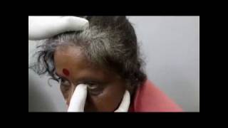 ROPLAS test ve  Regurgitation On Pressure over Lacrimal Sac   Dr Dinesh Kumar [upl. by Otsirave]