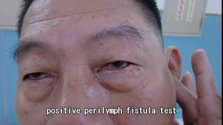 Positive perilymph fistula test [upl. by Enidlarej]