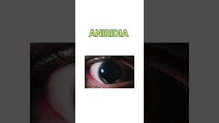 aniridiadefinationcausesymptomtreatmenthumanhuman eyeeyedisease mbbviraltrendingeyefun [upl. by Orimisac]