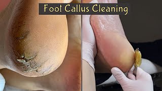 Callus Removal From Feet 👣 Foot Callus Removal Satisfying [upl. by Ttimme]