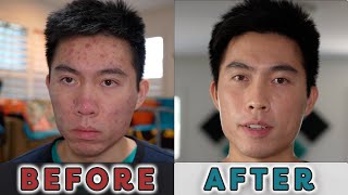 My Accutane Journey  Everything I Learned Along the Way [upl. by Jaworski]