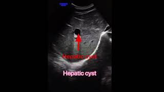 Hepatic cyst usgradiology usg4d ultrasound ultrasoundscans sonography medicalstudent medical [upl. by Aglo]