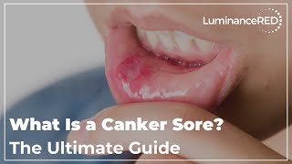 What Is a Canker Sore The Ultimate Guide [upl. by Kushner]