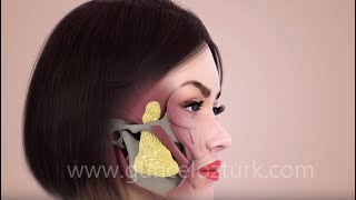 Bichectomy Fat Removal From The Cheek  Nefertiti Cheek  How is it done Guncel Ozturk MD [upl. by Atirehs116]