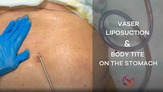 Vaser Liposuction and BodyTite on the Stomach  Dr Shalini Gupta [upl. by Zosi]