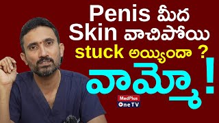 Paraphimosis  Penis మీద Skin వాచిపోయి stuck అయ్యిందా   DrSurendra Reddy MedPlusONETV [upl. by Enail850]