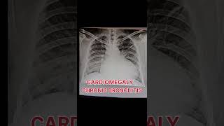 Cardiomegaly and chronic bronchitis shortvideo [upl. by Candless]