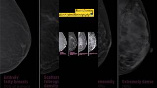 Mammogrammammographybreastscreeningcancerearlydiagnosisriskfactorsbreastcancerawareness [upl. by Sarchet]