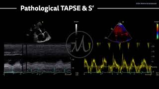 〖Echocardiography〗 Pathological S amp TAPSE [upl. by Norrat]