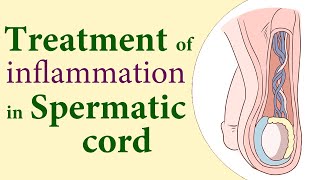 Treatment of Inflammation in Spermatic Cord [upl. by Lamson]