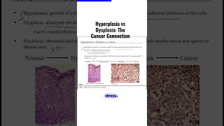 Hyperplasia vs Dysplasia The Cancer Connection [upl. by Demakis652]