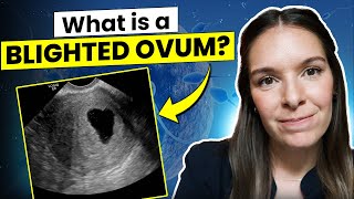 Understanding Blighted Ovum Signs Diagnosis and Management [upl. by Franci]