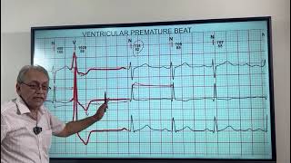 VENTRICULAR ECTOPICS  VENTRICULAR PREMATURE BEATS HOW TO DIAGNOSE ON ECG [upl. by Naimerej]