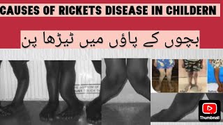 causes of rickets disease in childern health medicalinformation [upl. by Neerod532]