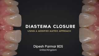 Diastema Closure Perfection  Using a modified matrix approach [upl. by Liss]