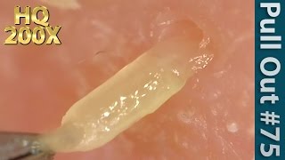 75 Pull Out Blackheads Close up 200X  Blackheads Removal [upl. by Ebeohp653]