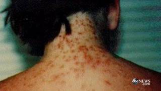 Sea Lice Outbreaks on the Rise in Beaches [upl. by Moersch]