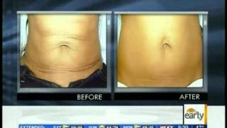 Exilis Body Contouring  Ultrasound Fat Reduction  Exilis Day [upl. by Quint695]