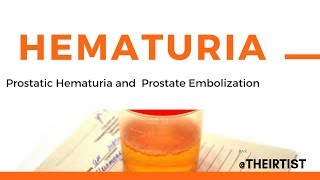 Prostate Hematuria  Blood in urine and PAE  prostate artery embolization [upl. by Nayra971]