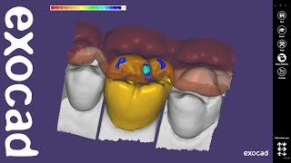 exocad Video Tutorial Basic Features  Anatomic Coping with Cutback [upl. by Jannel]