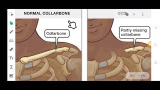 CLEIDOCRANIAL DYSPLASIA  IN JUST 5 MINUTES  SIMPLE AND EASY [upl. by Hilel]