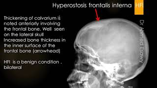 CASE 608 Hyperostosis frontalis interna HFI [upl. by Ruhtua]